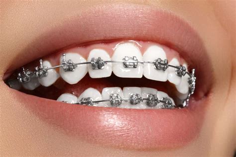 precio ortodoncia brackets metalicos|what are brackets in braces.